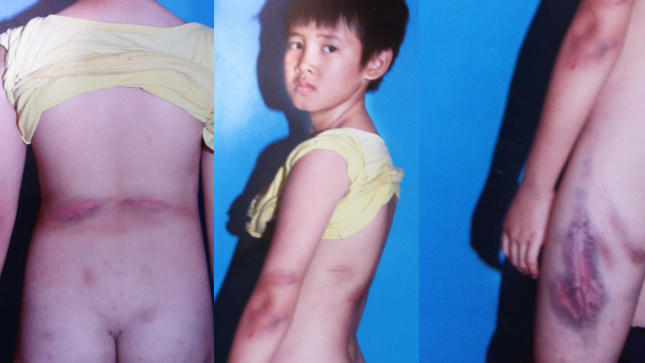 Rùng mình nghe cậu bé kể chuyện bị mẹ ghẻ tra tấn